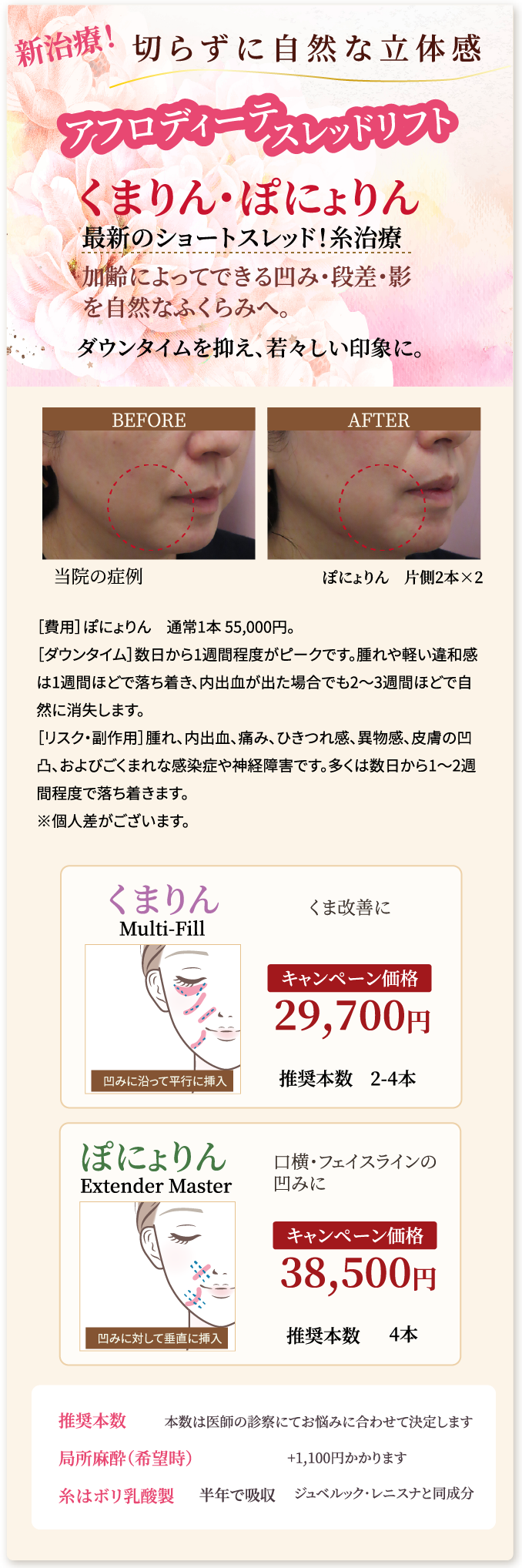新治療！切らずに自然な立体感。アフロディーテスレッドリフト。くまりん・ぽにょりん