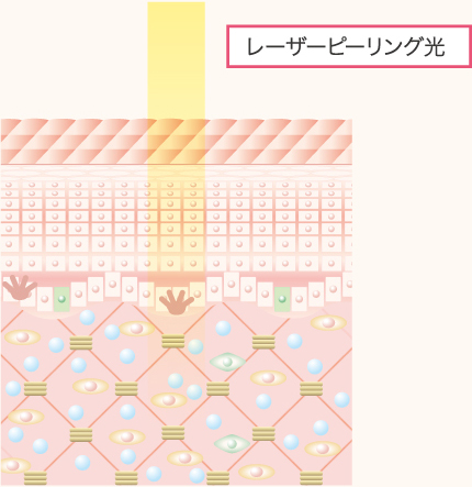 レーザーピーリング光